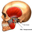 tmj lawyer edmonton - jaw/skull