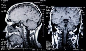 Brain Injury Claim Amount