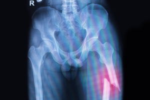 fracture-broken-femur-claim